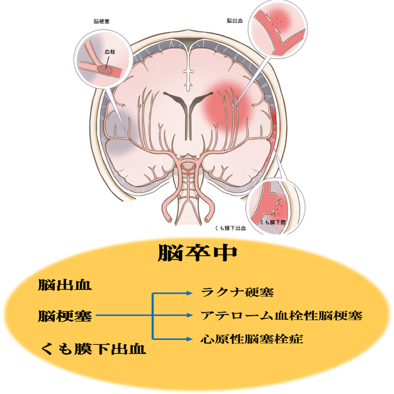 脳梗塞とは