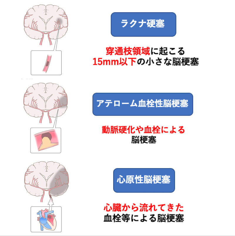 脳梗塞の治療方法とは