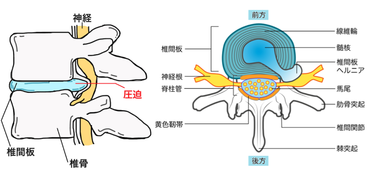 腰椎椎間板ヘルニアとは