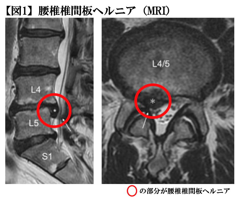 腰椎椎間板ヘルニアの治療方法とは