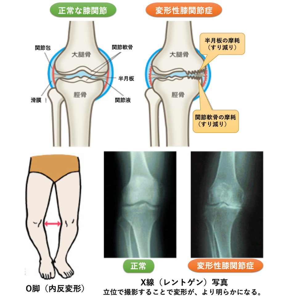変形性膝関節症とは