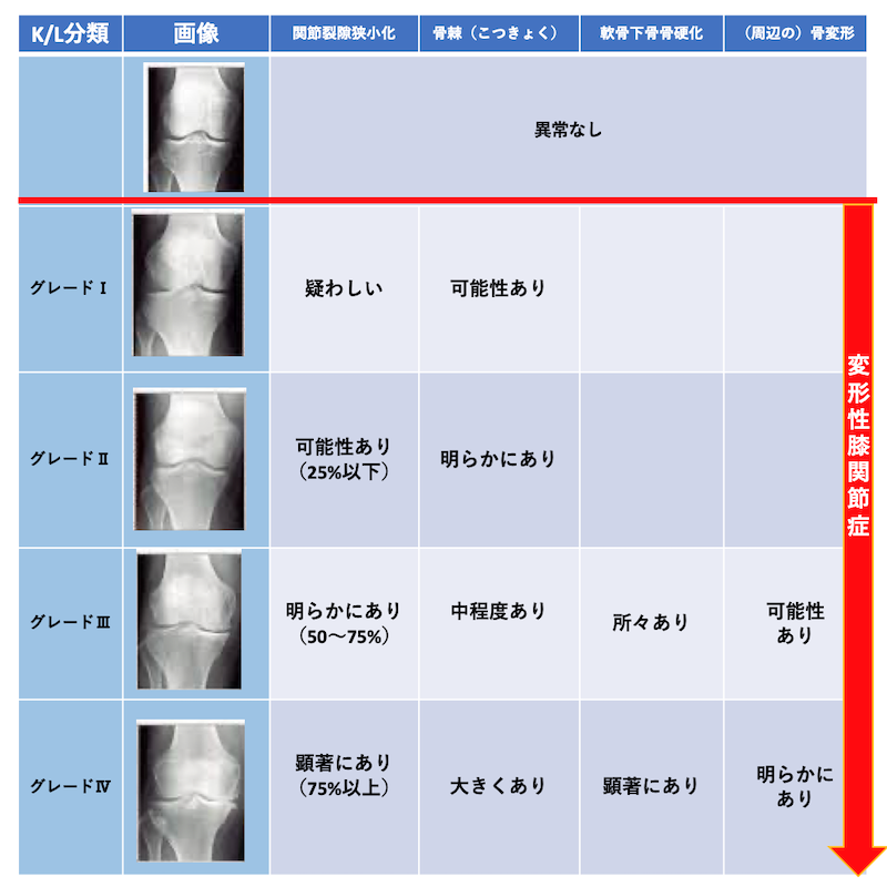 変形性膝関節症の治療方法とは