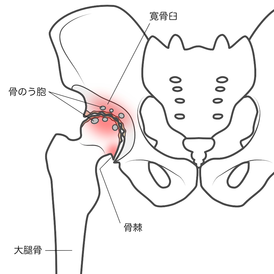 変形性股関節症とは