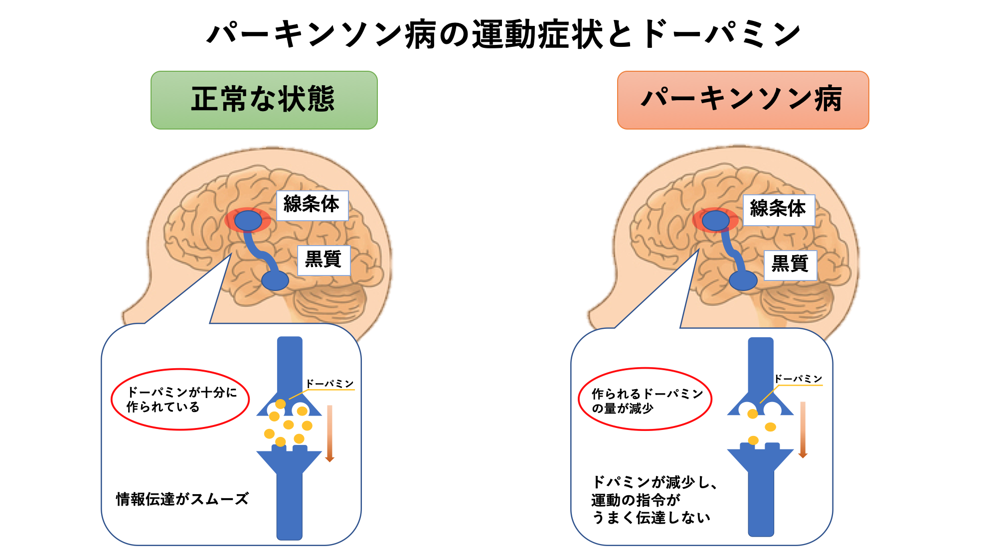 パーキンソン病とは