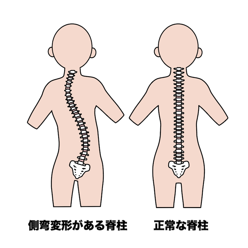側弯症とは