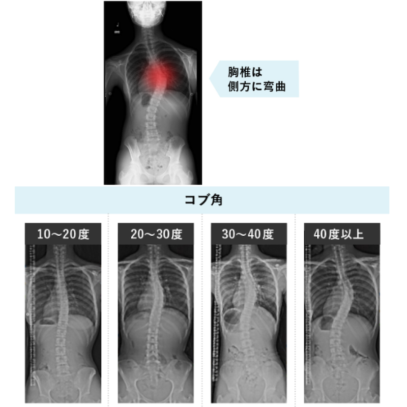 側弯症の治療方法とは