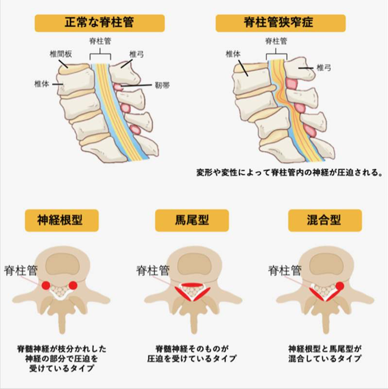 脊柱管狭窄症のリハビリとは