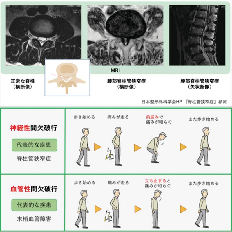 脊柱管狭窄症のリハビリとは