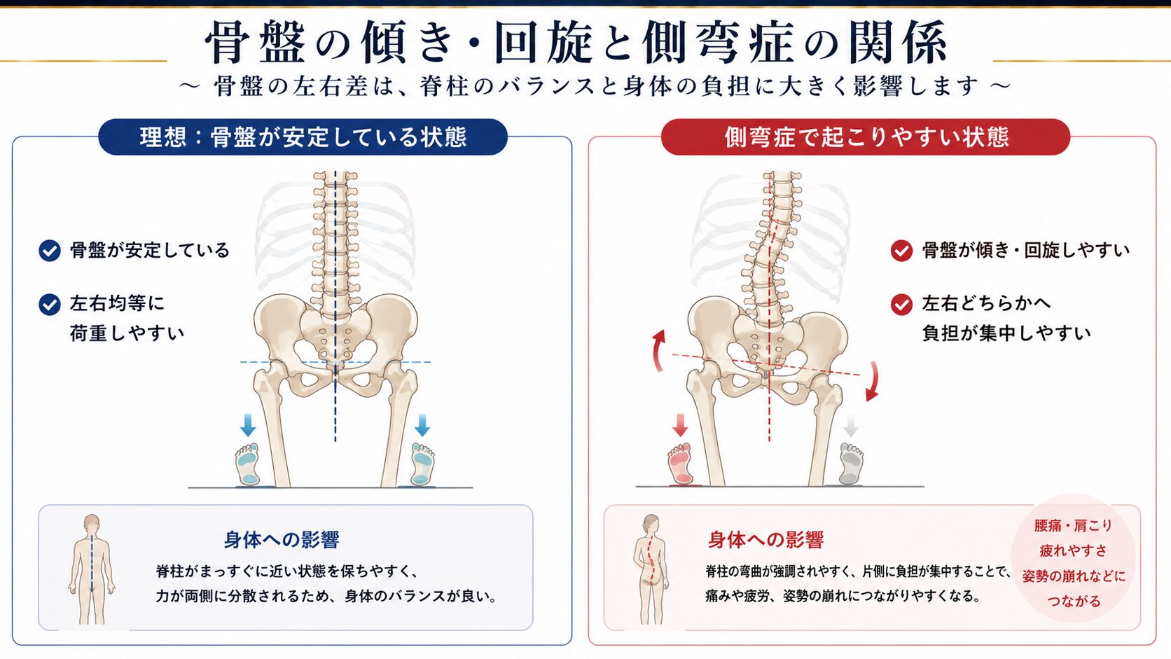 側弯症 骨盤回旋 ねじれ 概念図