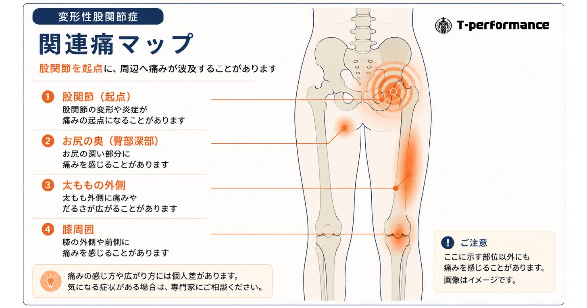 変形性股関節症 股関節を起点にお尻・太もも外側・膝へ痛みが波及する部位のイメージ図